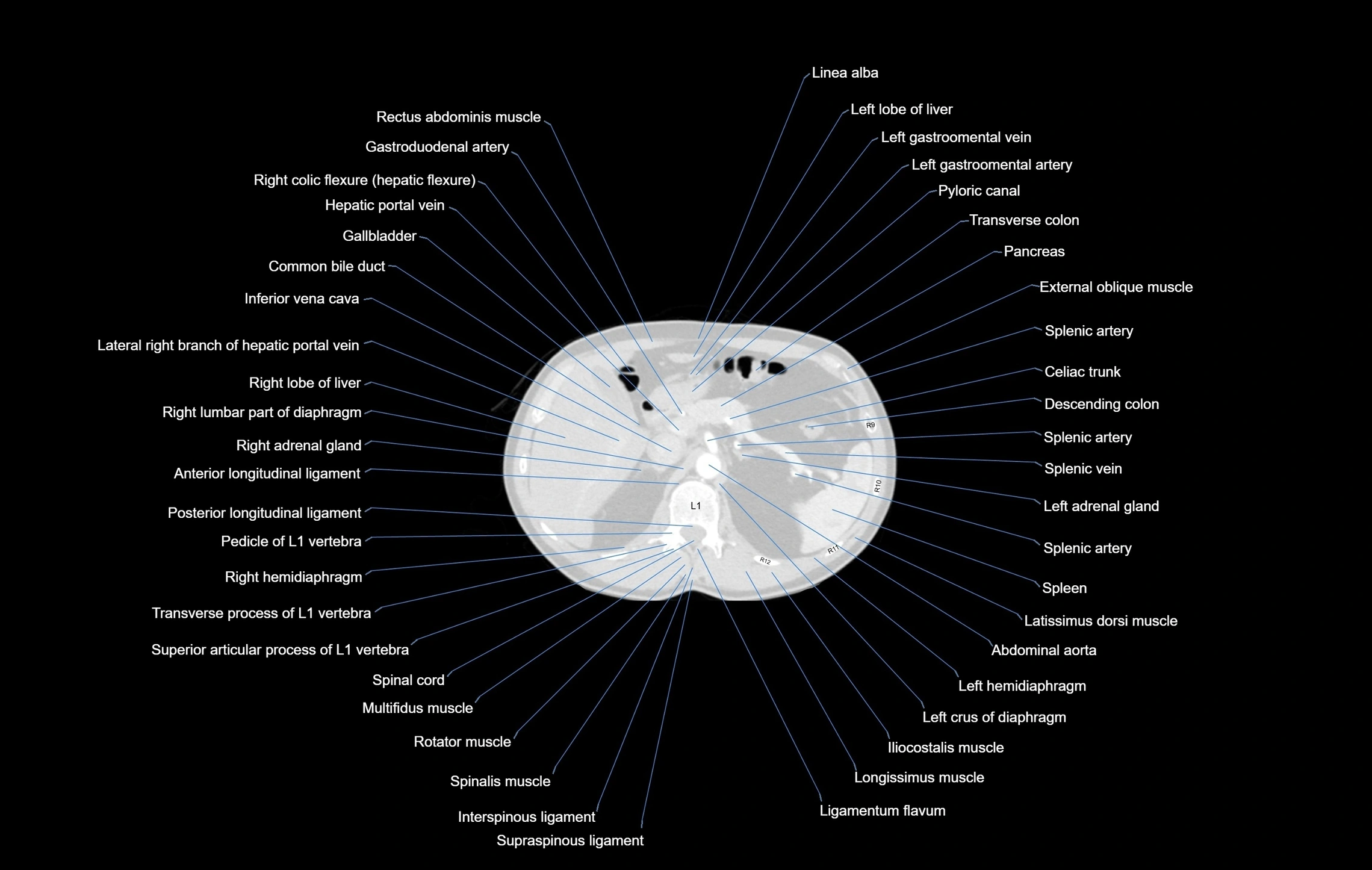 CT chest (thorax) labelled axial cross sectional anatomy radiology image-00123.webp